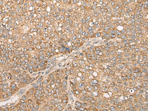 CAPN15 / SOLH Antibody - Immunohistochemistry of paraffin-embedded Human liver cancer tissue  using CAPN15 Polyclonal Antibody at dilution of 1:50(×200)