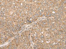 CAPN15 / SOLH Antibody - Immunohistochemistry of paraffin-embedded Human liver cancer tissue  using CAPN15 Polyclonal Antibody at dilution of 1:50(×200)