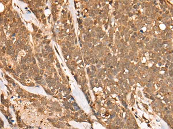 CAPN15 / SOLH Antibody - Immunohistochemistry of paraffin-embedded Human thyroid cancer tissue  using CAPN15 Polyclonal Antibody at dilution of 1:50(×200)