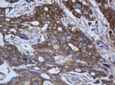 CAPN2 / Calpain 2 / M-Calpain Antibody - IHC of paraffin-embedded Adenocarcinoma of Human breast tissue using anti-CAPN2 mouse monoclonal antibody. (Heat-induced epitope retrieval by 10mM citric buffer, pH6.0, 120°C for 3min).