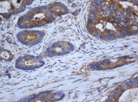 CAPN2 / Calpain 2 / M-Calpain Antibody - IHC of paraffin-embedded Adenocarcinoma of Human colon tissue using anti-CAPN2 mouse monoclonal antibody. (Heat-induced epitope retrieval by 10mM citric buffer, pH6.0, 120°C for 3min).