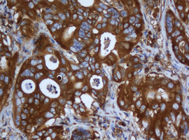 CAPN2 / Calpain 2 / M-Calpain Antibody - IHC of paraffin-embedded Carcinoma of Human liver tissue using anti-CAPN2 mouse monoclonal antibody. (Heat-induced epitope retrieval by 10mM citric buffer, pH6.0, 120°C for 3min).