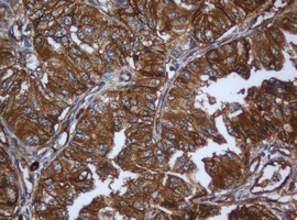 CAPN2 / Calpain 2 / M-Calpain Antibody - IHC of paraffin-embedded Carcinoma of Human pancreas tissue using anti-CAPN2 mouse monoclonal antibody. (Heat-induced epitope retrieval by 10mM citric buffer, pH6.0, 120°C for 3min).