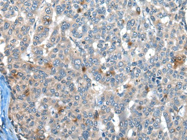 CAPN3 / Calpain 3 Antibody - Immunohistochemistry of paraffin-embedded Human liver cancer tissue  using CAPN3 Polyclonal Antibody at dilution of 1:30(×200)