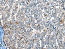 CAPN3 / Calpain 3 Antibody - Immunohistochemistry of paraffin-embedded Human liver cancer tissue  using CAPN3 Polyclonal Antibody at dilution of 1:30(×200)