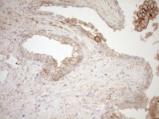 CAPN5 / Calpain 5 Antibody - Immunohistochemical staining of paraffin-embedded Carcinoma of Human prostate tissue using anti-CAPN5 mouse monoclonal antibody. (Heat-induced epitope retrieval by 1mM EDTA in 10mM Tris buffer. (pH8.5) at 120°C for 3 min. (1:150)
