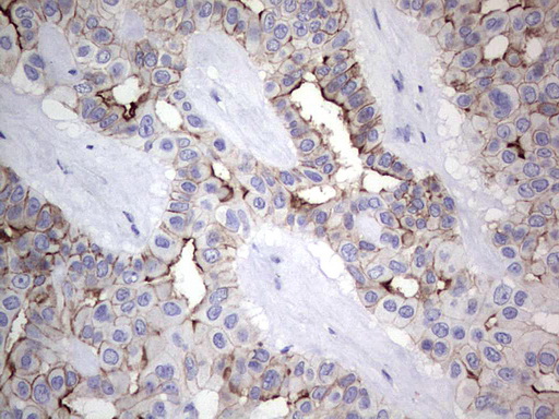 CAPN5 / Calpain 5 Antibody - Immunohistochemical staining of paraffin-embedded Carcinoma of Human liver tissue using anti-CAPN5 mouse monoclonal antibody. (Heat-induced epitope retrieval by 1 mM EDTA in 10mM Tris, pH8.5, 120C for 3min,