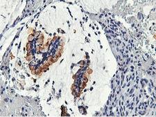 CAPN9 / Calpain 9 Antibody - IHC of paraffin-embedded Adenocarcinoma of Human colon tissue using anti-CAPN9 mouse monoclonal antibody.