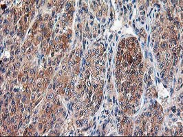 CAPN9 / Calpain 9 Antibody - IHC of paraffin-embedded Carcinoma of Human liver tissue using anti-CAPN9 mouse monoclonal antibody.