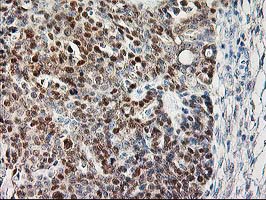 CAPN9 / Calpain 9 Antibody - IHC of paraffin-embedded Adenocarcinoma of Human ovary tissue using anti-CAPN9 mouse monoclonal antibody.