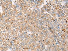 CAPN9 / Calpain 9 Antibody - Immunohistochemistry of paraffin-embedded Human liver cancer tissue  using CAPN9 Polyclonal Antibody at dilution of 1:45(×200)