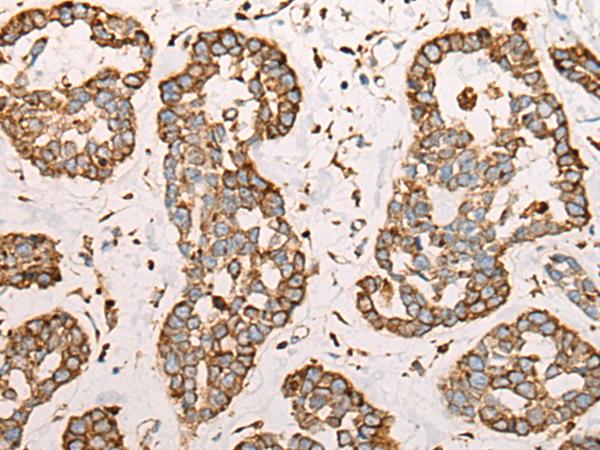 CAPN9 / Calpain 9 Antibody - Immunohistochemistry of paraffin-embedded Human esophagus cancer tissue  using CAPN9 Polyclonal Antibody at dilution of 1:45(×200)