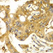 CAPNS1 / CAPN4 Antibody - Immunohistochemistry of paraffin-embedded human liver cancer tissue.