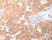 CAPNS1 / CAPN4 Antibody - Immunohistochemistry of paraffin-embedded Human ovarian cancer using CAPNS1 Polyclonal Antibody at dilution of 1:60.