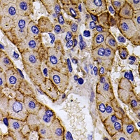 CAPNS1 / CAPN4 Antibody - Immunohistochemical analysis of Calpain reg staining in human liver cancer formalin fixed paraffin embedded tissue section. The section was pre-treated using heat mediated antigen retrieval with sodium citrate buffer (pH 6.0). The section was then incubated with the antibody at room temperature and detected using an HRP conjugated compact polymer system. DAB was used as the chromogen. The section was then counterstained with hematoxylin and mounted with DPX.
