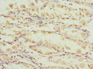 CAPNS1 / CAPN4 Antibody - Immunohistochemistry of paraffin-embedded human gastric cancer at dilution 1:100