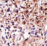 CAPRIN1 Antibody - Formalin-fixed and paraffin-embedded human cancer tissue reacted with the primary antibody, which was peroxidase-conjugated to the secondary antibody, followed by DAB staining. This data demonstrates the use of this antibody for immunohistochemistry; clinical relevance has not been evaluated. BC = breast carcinoma; HC = hepatocarcinoma.
