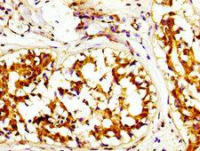 CAPRIN1 Antibody - Immunohistochemistry image at a dilution of 1:200 and staining in paraffin-embedded human breast cancer performed on a Leica BondTM system. After dewaxing and hydration, antigen retrieval was mediated by high pressure in a citrate buffer (pH 6.0) . Section was blocked with 10% normal goat serum 30min at RT. Then primary antibody (1% BSA) was incubated at 4 °C overnight. The primary is detected by a biotinylated secondary antibody and visualized using an HRP conjugated SP system.