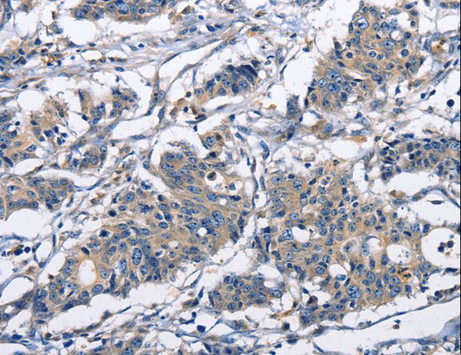 CAPZA2 / CAPZ Alpha 2 Antibody - Immunohistochemistry of paraffin-embedded Human gastric cancer using CAPZA2 Polyclonal Antibody at dilution of 1:30.