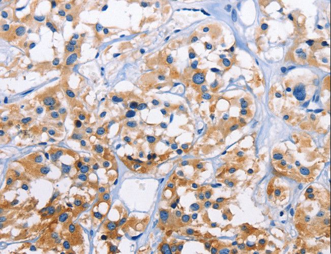 CAPZA3 Antibody - Immunohistochemistry of paraffin-embedded Human thyroid cancer using CAPZA3 Polyclonal Antibody at dilution of 1:70.