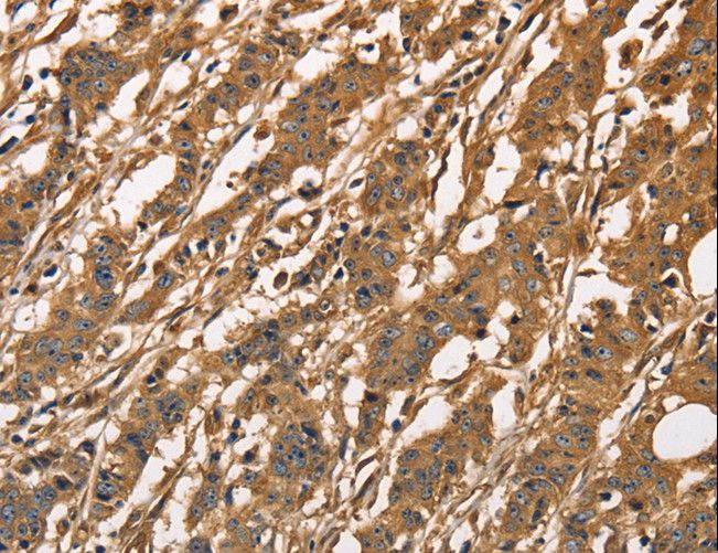 CAPZA3 Antibody - Immunohistochemistry of paraffin-embedded Human esophagus cancer using CAPZA3 Polyclonal Antibody at dilution of 1:40.