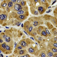 Carboxylesterase 1 / CES1 Antibody - Immunohistochemical analysis of CES1 staining in human liver cancer formalin fixed paraffin embedded tissue section. The section was pre-treated using heat mediated antigen retrieval with sodium citrate buffer (pH 6.0). The section was then incubated with the antibody at room temperature and detected using an HRP conjugated compact polymer system. DAB was used as the chromogen. The section was then counterstained with hematoxylin and mounted with DPX.