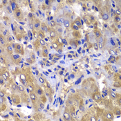 CARD10 / CARMA3 Antibody - Immunohistochemistry of paraffin-embedded human liver injury tissue.