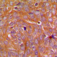 CARD14 Antibody - Immunohistochemical analysis of CARD14 staining in human breast cancer formalin fixed paraffin embedded tissue section. The section was pre-treated using heat mediated antigen retrieval with sodium citrate buffer (pH 6.0). The section was then incubated with the antibody at room temperature and detected using an HRP conjugated compact polymer system. DAB was used as the chromogen. The section was then counterstained with hematoxylin and mounted with DPX.