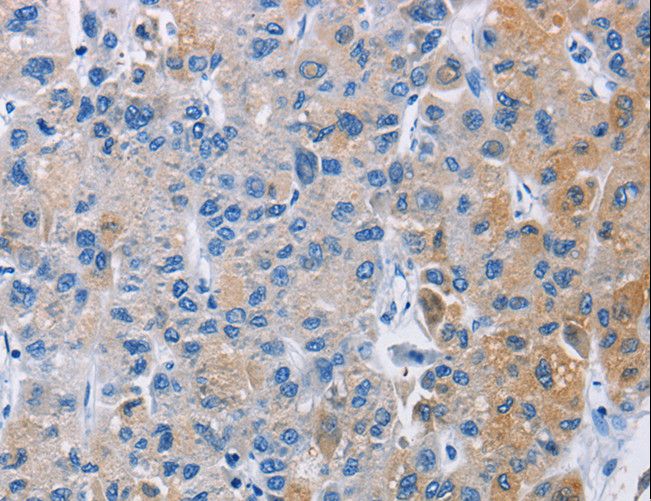 CARD14 Antibody - Immunohistochemistry of paraffin-embedded Human liver cancer using CARD14 Polyclonal Antibody at dilution of 1:30.