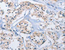 CARD14 Antibody - Immunohistochemistry of paraffin-embedded Human thyroid cancer using CARD14 Polyclonal Antibody at dilution of 1:30.