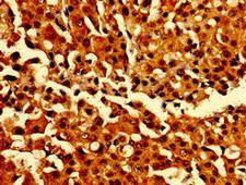 CARD14 Antibody - Immunohistochemistry image of paraffin-embedded human breast cancer at a dilution of 1:100