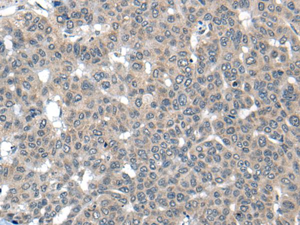 CARD16 / COP Antibody - Immunohistochemistry of paraffin-embedded Human liver cancer tissue  using CARD16 Polyclonal Antibody at dilution of 1:55(×200)