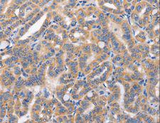 CARD17 / INCA Antibody - Immunohistochemistry of paraffin-embedded Human liver cancer using CARD17 Polyclonal Antibody at dilution of 1:50.