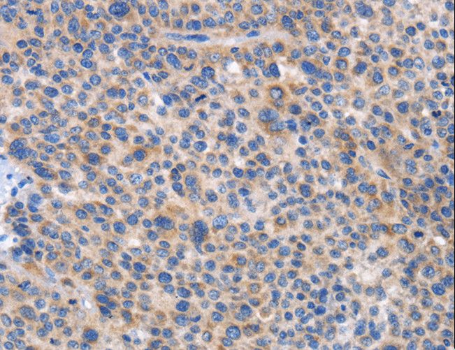 CARD17 / INCA Antibody - Immunohistochemistry of paraffin-embedded Human liver cancer using CARD17 Polyclonal Antibody at dilution of 1:50.
