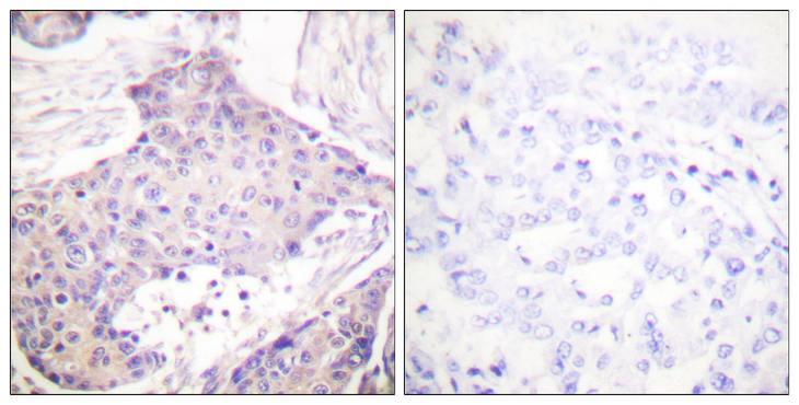 CARD6 Antibody - Immunohistochemistry analysis of paraffin-embedded human breast carcinoma tissue, using CARD6 Antibody. The picture on the right is blocked with the synthesized peptide.