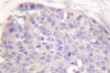 CARD6 Antibody - IHC of CARD6/CINCIN1 (A2) pAb in paraffin-embedded human breast carcinoma tissue.
