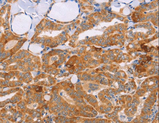 CARD6 Antibody - Immunohistochemistry of paraffin-embedded Human cervical cancer using CARD6 Polyclonal Antibody at dilution of 1:60.