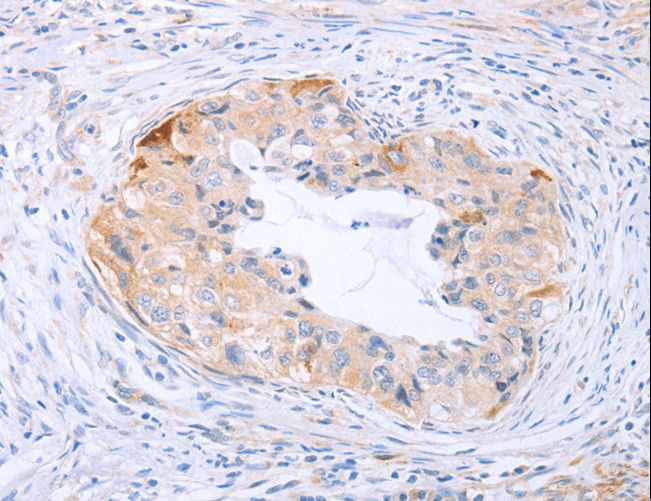 CARD6 Antibody - Immunohistochemistry of paraffin-embedded Human cervical cancer using CARD6 Polyclonal Antibody at dilution of 1:60.