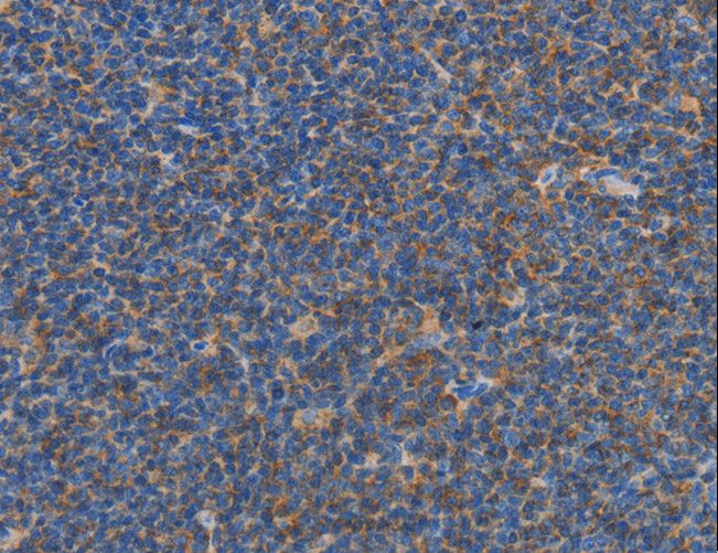 CARD6 Antibody - Immunohistochemistry of paraffin-embedded Human Lymphoma using CARD6 Polyclonal Antibody at dilution of 1:60.