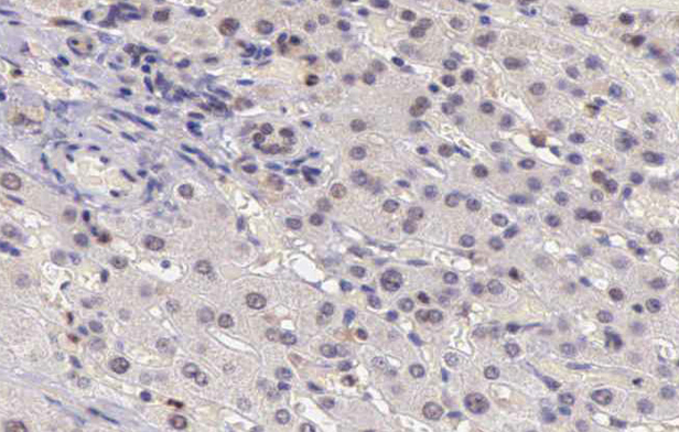 CARD6 Antibody - 1:200 staining human liver carcinoma tissues by IHC-P. The tissue was formaldehyde fixed and a heat mediated antigen retrieval step in citrate buffer was performed. The tissue was then blocked and incubated with the antibody for 1.5 hours at 22°C. An HRP conjugated goat anti-rabbit antibody was used as the secondary.