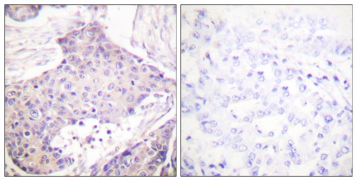 CARD6 Antibody - Peptide - + Immunohistochemical analysis of paraffin-embedded human breast carcinoma tissue using CARD6 antibody.