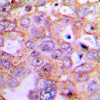 CARD6 Antibody - Immunohistochemical analysis of CARD6 staining in human lung cancer formalin fixed paraffin embedded tissue section. The section was pre-treated using heat mediated antigen retrieval with sodium citrate buffer (pH 6.0). The section was then incubated with the antibody at room temperature and detected using an HRP conjugated compact polymer system. DAB was used as the chromogen. The section was then counterstained with hematoxylin and mounted with DPX.