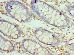 CARD8 / Cardinal / TUCAN Antibody - Immunohistochemistry of paraffin-embedded human rectal cancer using antibody at 1:100 dilution.