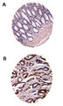 CARD8 / Cardinal / TUCAN Antibody - Formalin-fixed, paraffin-embedded human colon tissue sections labeled for TUCAN using Polyclonal Antibody to TUCAN/CARD8 at 1:2000. Hematoxylin-Eosin counterstain. A, normal adjacent colonic epithelium. B, matched malignant colonic epithelium shown in a region of invasive cancer. A and B are from the same colon carcinoma patient.