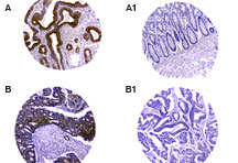 CARD8 / Cardinal / TUCAN Antibody - Formalin-fixed, paraffin-embedded tumor/normal adjacent tissue cores from a human colontissue microarray stained for TUCAN/CARD8 expression at 1:2000 using Polyclonal Antibody to TUCAN/CARD8. A and B are tumor tissue cores. A1 and B1 are the matched normal adjacent cores from A and B, respectively. Hematoxylin-Eos in counterstain.