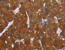 CARD9 Antibody - Immunohistochemistry of paraffin-embedded Human thyroid cancer using CARD9 Polyclonal Antibody at dilution of 1:70.