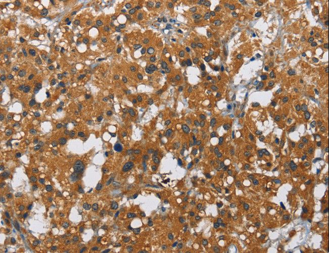 CARD9 Antibody - Immunohistochemistry of paraffin-embedded Human thyroid cancer using CARD9 Polyclonal Antibody at dilution of 1:70.
