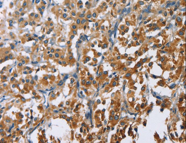 CARD9 Antibody - Immunohistochemistry of paraffin-embedded Human cervical cancer using CARD9 Polyclonal Antibody at dilution of 1:60.