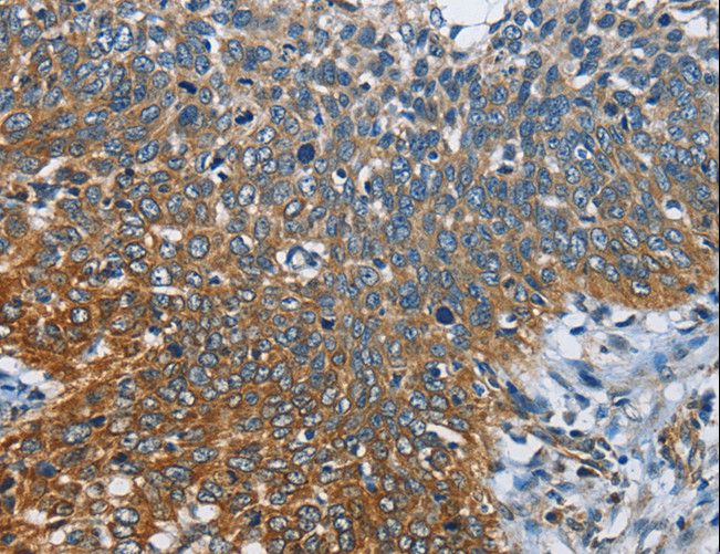 CARD9 Antibody - Immunohistochemistry of paraffin-embedded Human cervical cancer using CARD9 Polyclonal Antibody at dilution of 1:60.