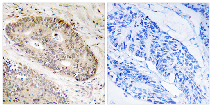 CARF / ALS2CR8 Antibody - Immunohistochemistry analysis of paraffin-embedded human lung carcinoma tissue, using ALS2CR8 Antibody. The picture on the right is blocked with the synthesized peptide.